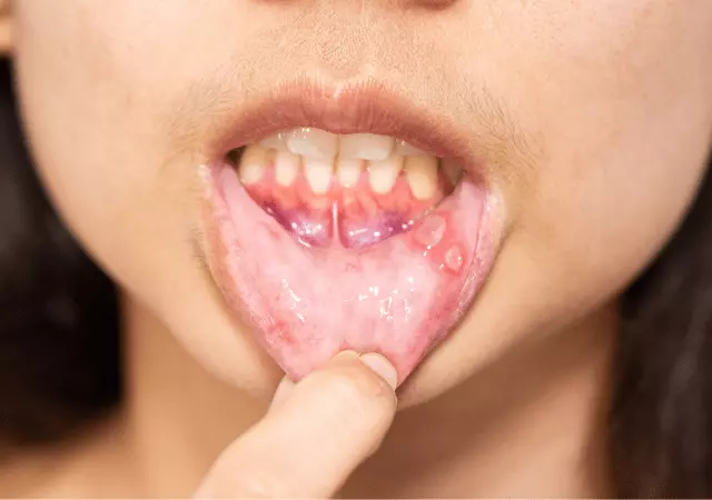 benefits of peppermint oil for canker sores