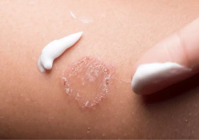 best essential oils for cellulitis