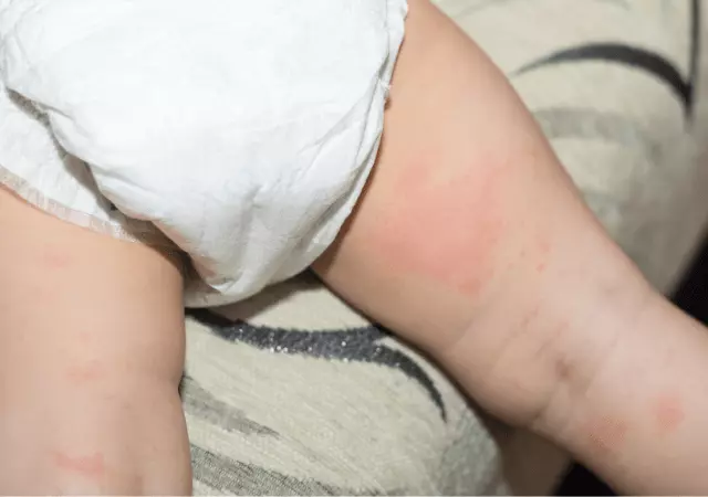 best essential oils for diaper rash