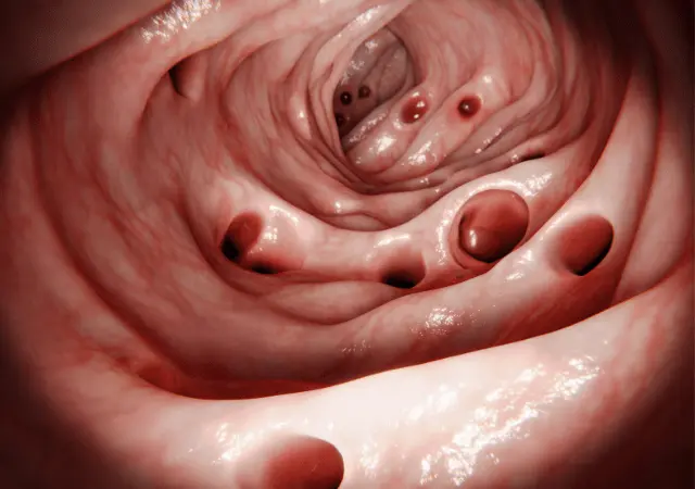 best essential oils for diverticulitis