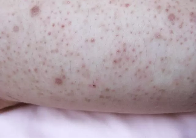 best essential oils for keratosis pilaris