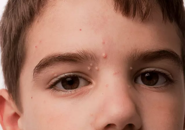 best essential oils for molluscum contagiosum