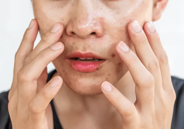 best essential oils for oily skin