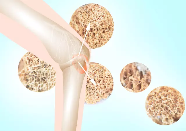 best essential oils for osteoporosis