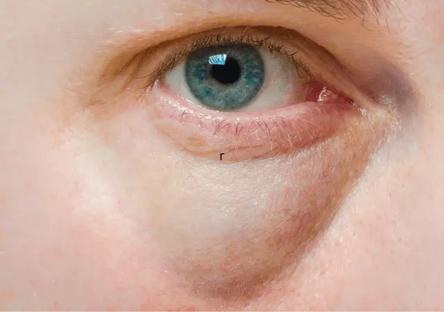 best essential oils for puffy eyes