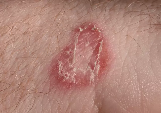 best essential oils for ringworms