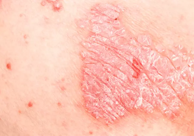 best essential oils for schamberg disease