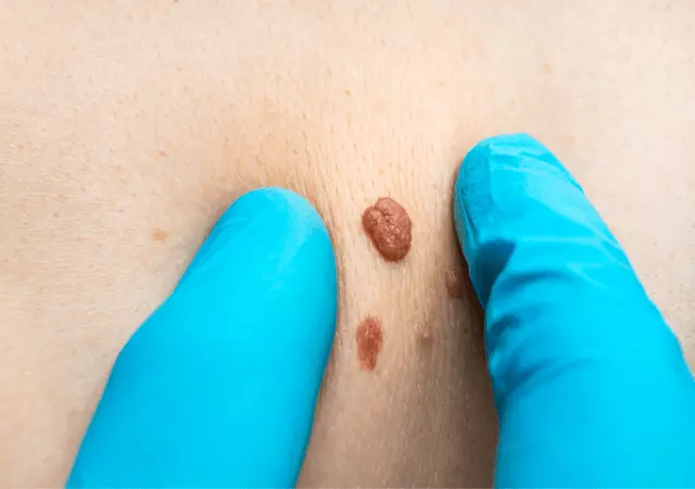 best essential oils for skin tags