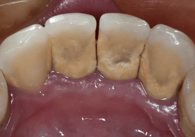 best essential oils for tartar removal